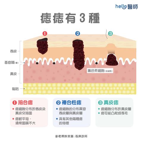 墨痣形成|墨形成：你真的瞭解嗎？